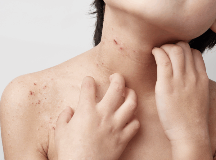 Dermatitis